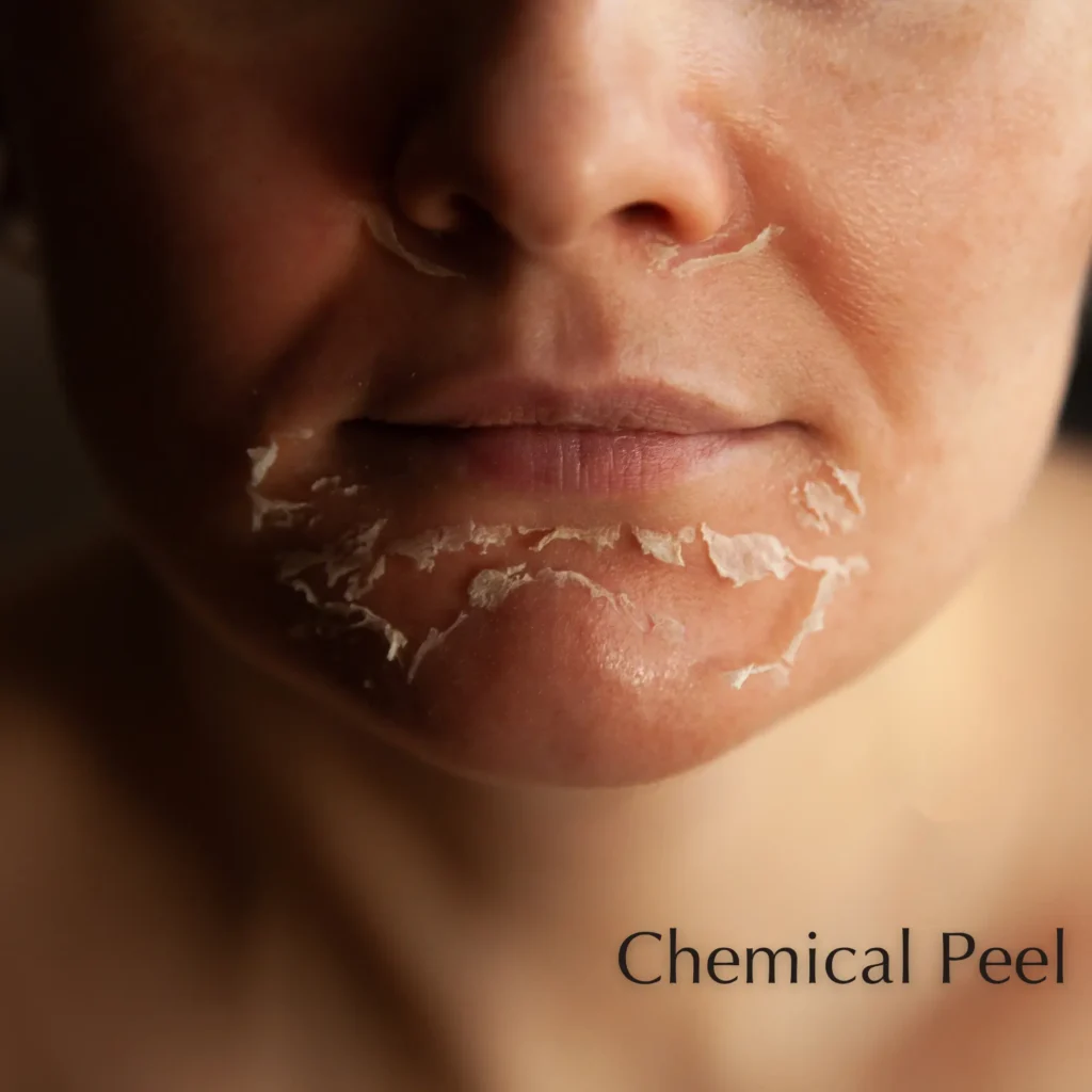 Chemical peel event poster