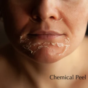 Chemical peel event poster