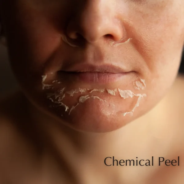 Chemical peel event poster